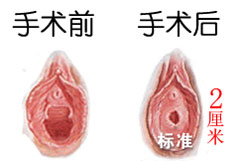 阴道紧缩重拾“性趣”?